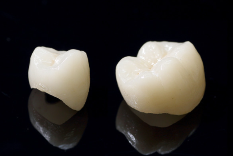 自然な歯を作る補綴技術